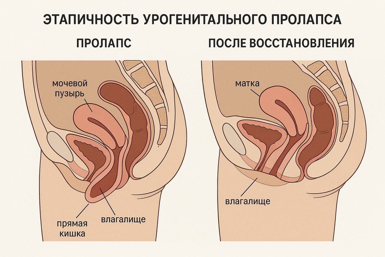 Пролапс тазовых органов (до и после восстановления)